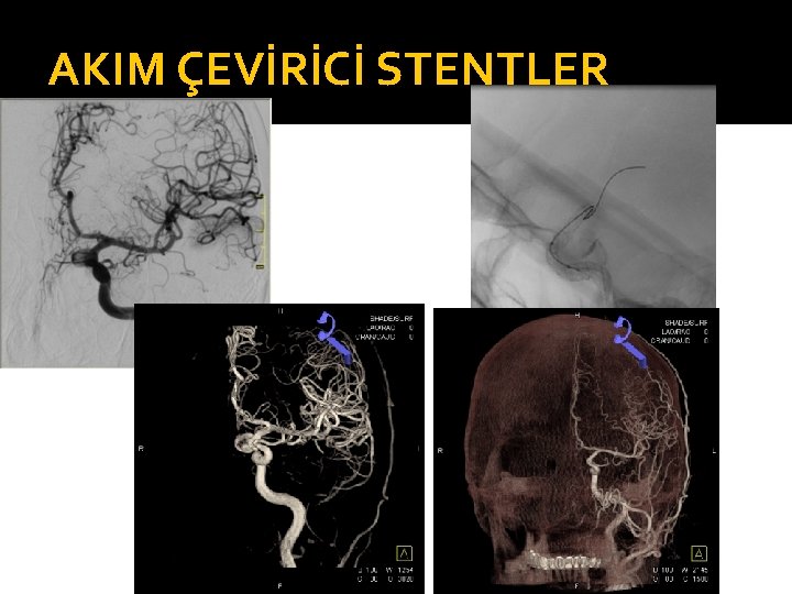 AKIM ÇEVİRİCİ STENTLER 