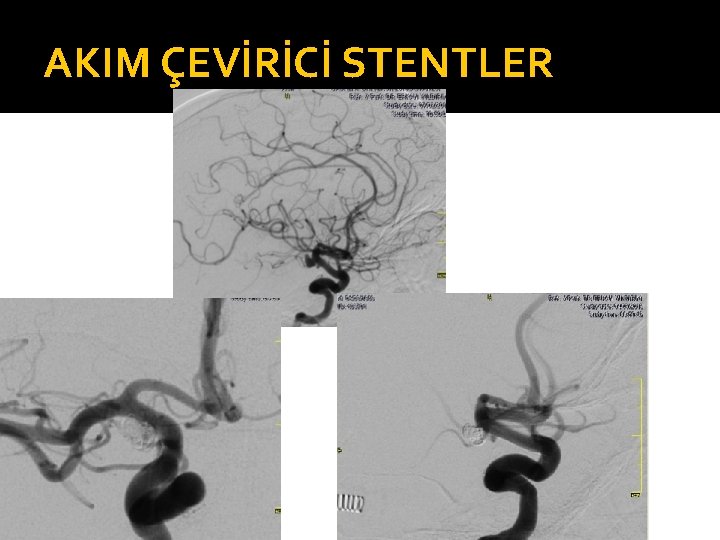 AKIM ÇEVİRİCİ STENTLER 