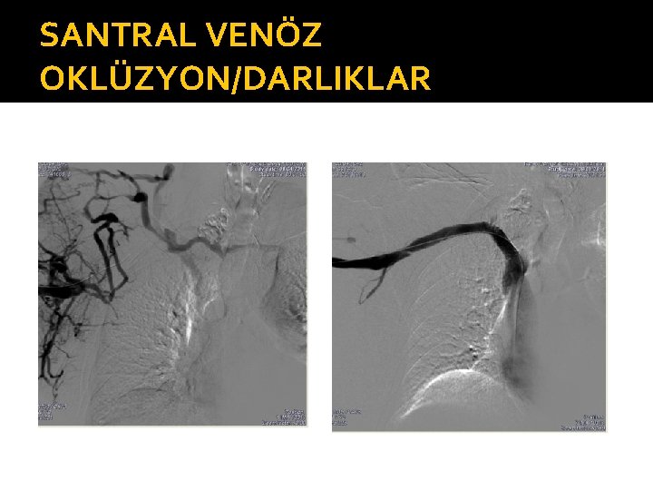 SANTRAL VENÖZ OKLÜZYON/DARLIKLAR 