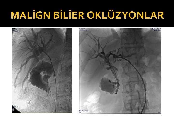 MALİGN BİLİER OKLÜZYONLAR 