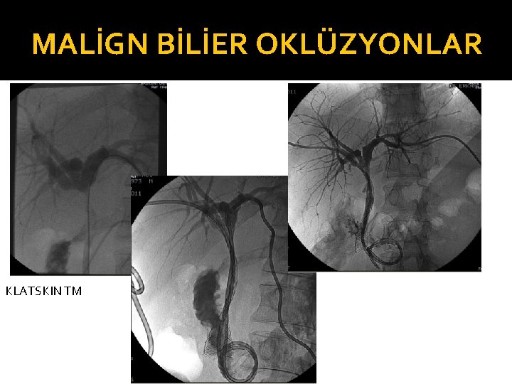 MALİGN BİLİER OKLÜZYONLAR KLATSKIN TM 