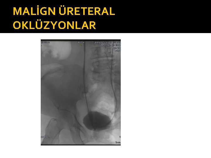 MALİGN ÜRETERAL OKLÜZYONLAR 