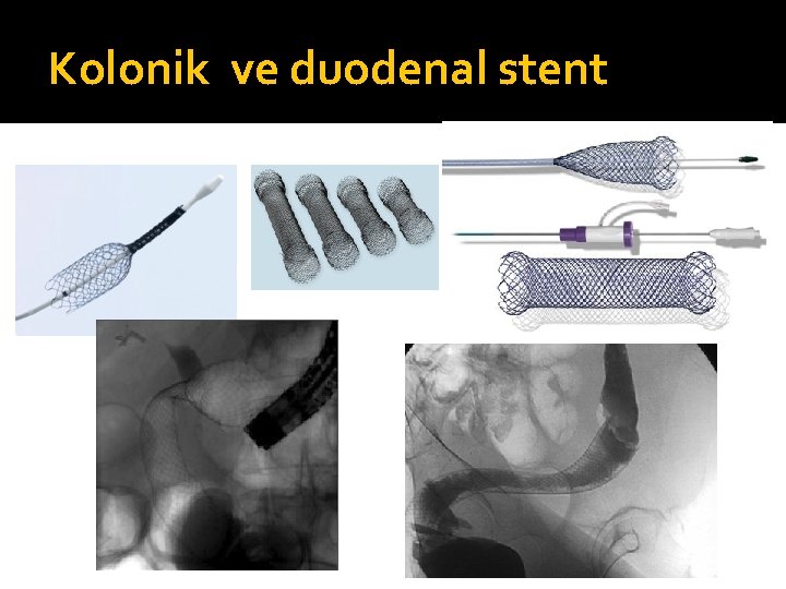 Kolonik ve duodenal stent 