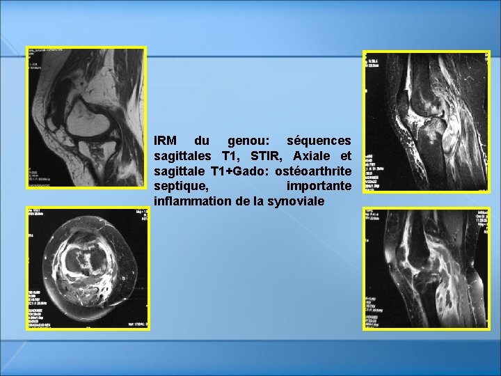 IRM du genou: séquences sagittales T 1, STIR, Axiale et sagittale T 1+Gado: ostéoarthrite IRM du genou: séquences sagittales T 1, STIR, Axiale et sagittale T 1+Gado: ostéoarthrite