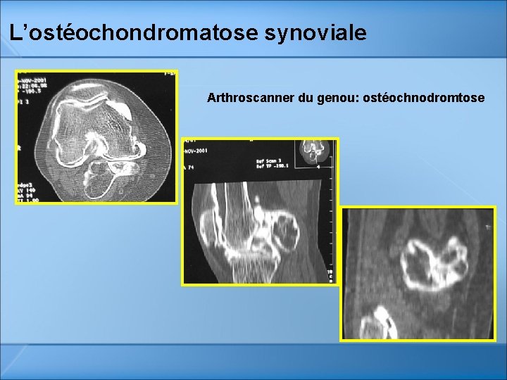 L’ostéochondromatose synoviale Arthroscanner du genou: ostéochnodromtose L’ostéochondromatose synoviale Arthroscanner du genou: ostéochnodromtose