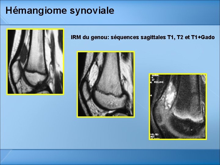 Hémangiome synoviale IRM du genou: séquences sagittales T 1, T 2 et T 1+Gado Hémangiome synoviale IRM du genou: séquences sagittales T 1, T 2 et T 1+Gado