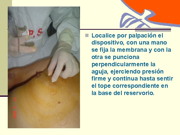 n Localice por palpación el dispositivo, con una mano se fija la membrana y