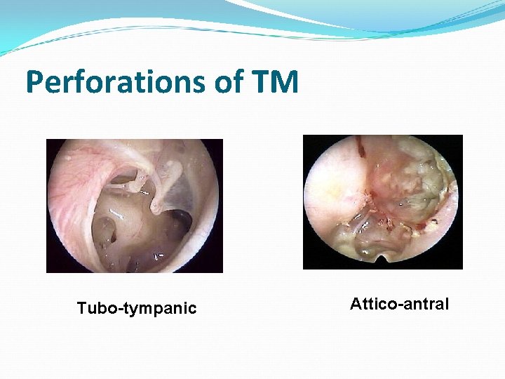 Perforations of TM Tubo-tympanic Attico-antral 