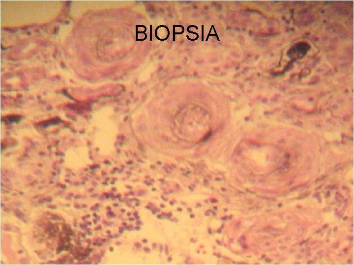 BIOPSIA 