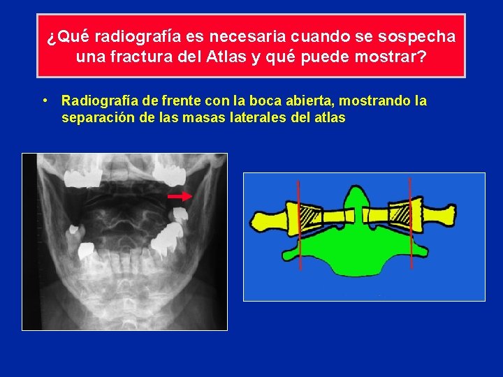 ¿Qué radiografía es necesaria cuando se sospecha una fractura del Atlas y qué puede