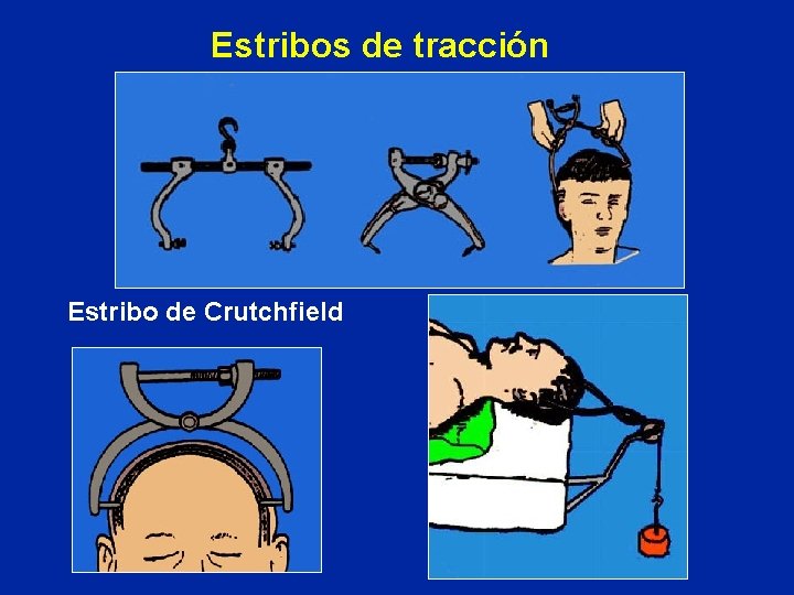Estribos de tracción Estribo de Crutchfield 