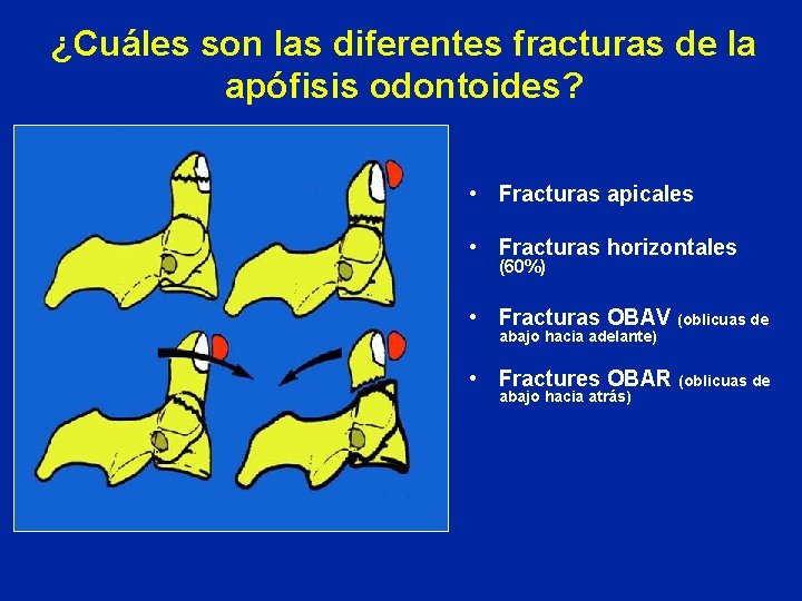 ¿Cuáles son las diferentes fracturas de la apófisis odontoides? • Fracturas apicales • Fracturas