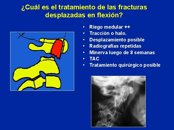 ¿Cuál es el tratamiento de las fracturas desplazadas en flexión? • • Riego medular