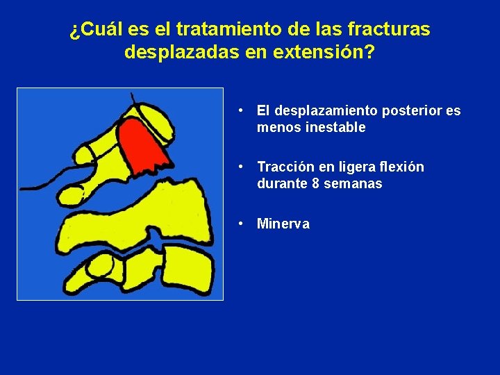 ¿Cuál es el tratamiento de las fracturas desplazadas en extensión? • El desplazamiento posterior