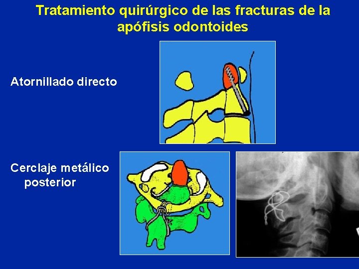Tratamiento quirúrgico de las fracturas de la apófisis odontoides Atornillado directo Cerclaje metálico posterior