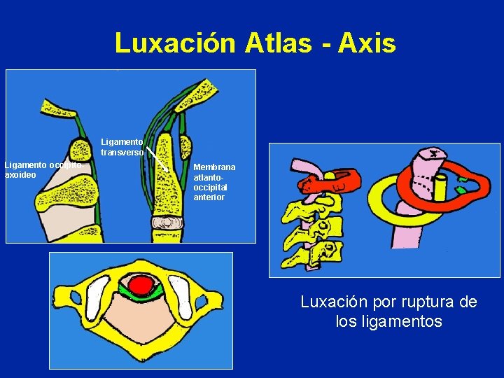 Luxación Atlas - Axis Ligamento transverso Ligamento occipitoaxoideo Membrana atlantooccipital anterior Luxación por ruptura