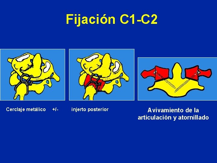 Fijación C 1 -C 2 Cerclaje metálico +/- injerto posterior Avivamiento de la articulación