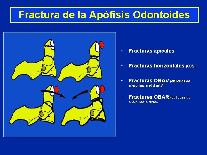 Fractura de la Apófisis Odontoides • Fracturas apicales • Fracturas horizontales (60%) • Fracturas