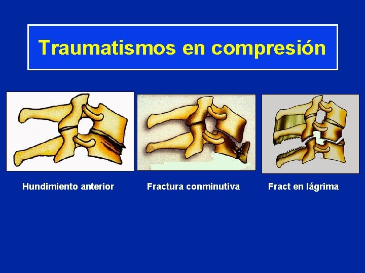 Traumatismos en compresión Hundimiento anterior Fractura conminutiva Fract en lágrima 