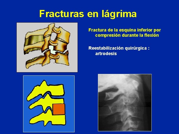 Fracturas en lágrima Fractura de la esquina inferior por compresión durante la flexión Reestabilización