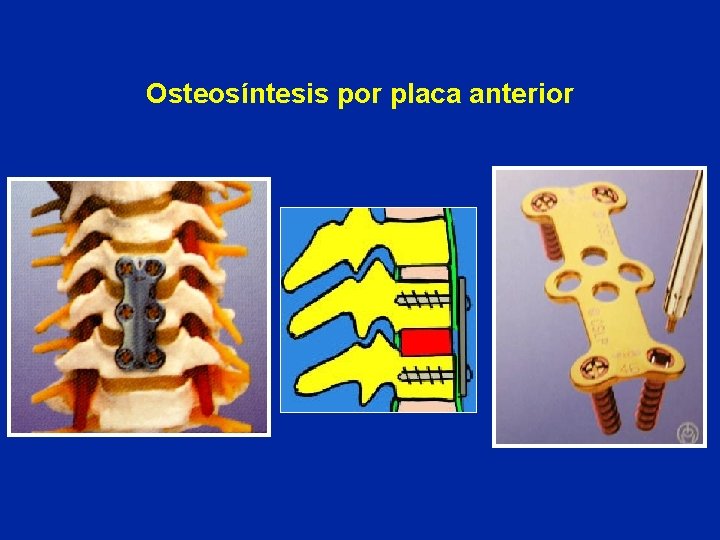 Osteosíntesis por placa anterior 