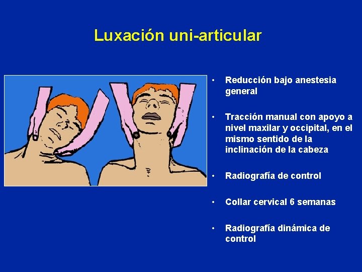 Luxación uni-articular • Reducción bajo anestesia general • Tracción manual con apoyo a nivel