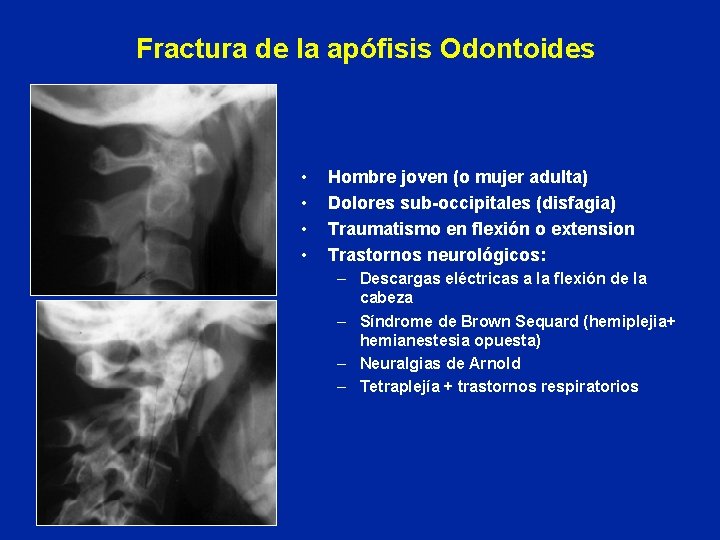 Fractura de la apófisis Odontoides • • Hombre joven (o mujer adulta) Dolores sub-occipitales