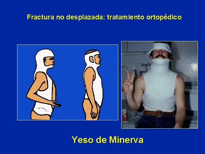 Fractura no desplazada: tratamiento ortopédico Yeso de Minerva 