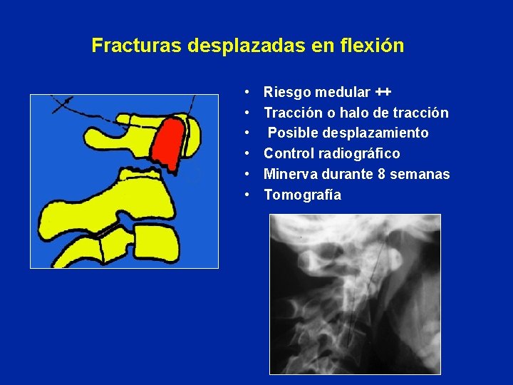 Fracturas desplazadas en flexión • • • Riesgo medular ++ Tracción o halo de