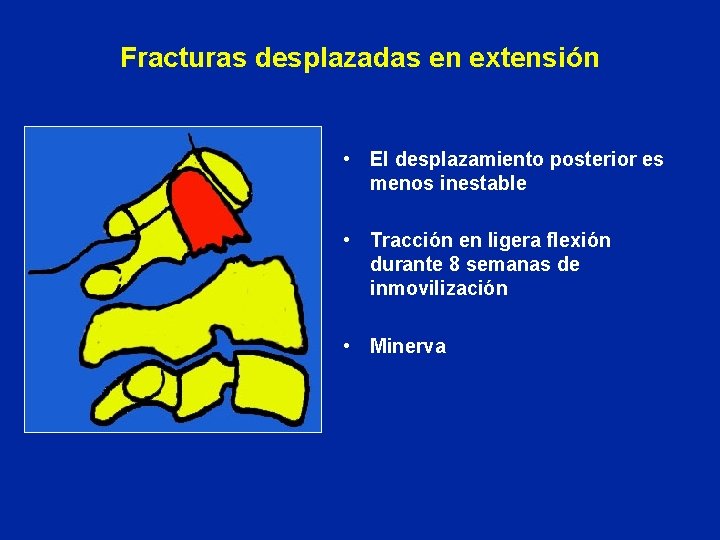 Fracturas desplazadas en extensión • El desplazamiento posterior es menos inestable • Tracción en