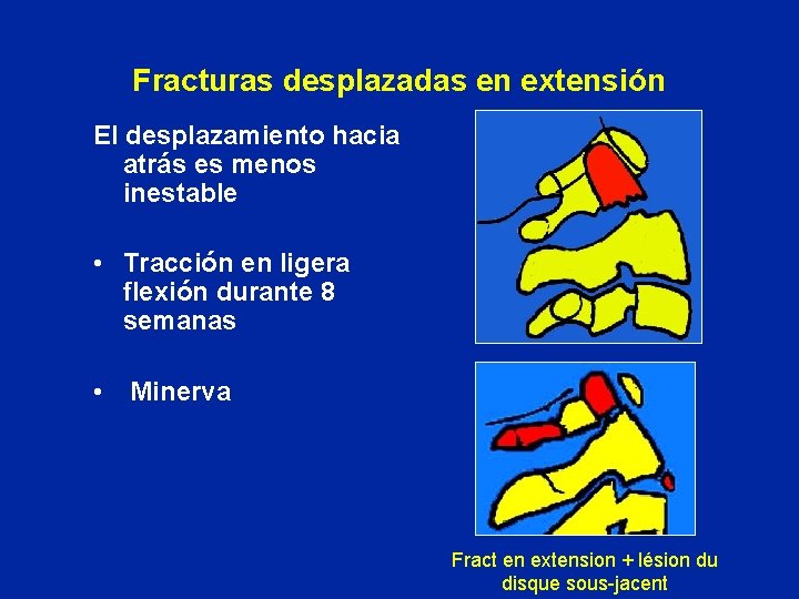 Fracturas desplazadas en extensión El desplazamiento hacia atrás es menos inestable • Tracción en