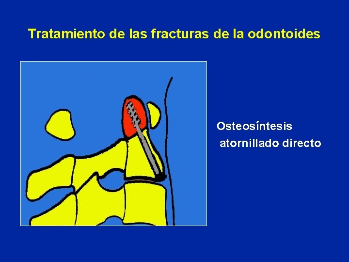 Tratamiento de las fracturas de la odontoides Osteosíntesis atornillado directo 