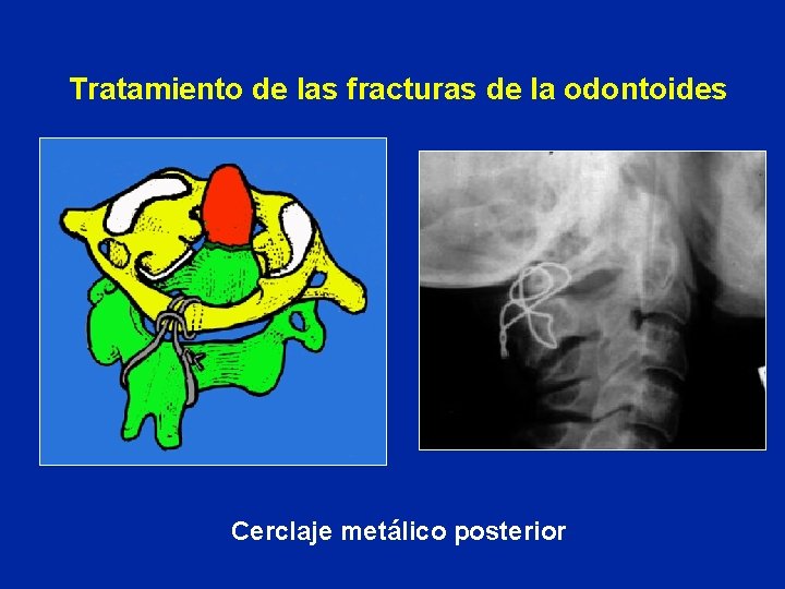 Tratamiento de las fracturas de la odontoides Cerclaje metálico posterior 