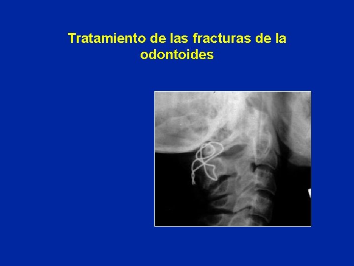 Tratamiento de las fracturas de la odontoides 