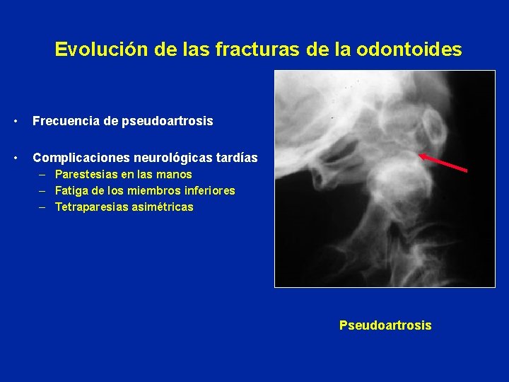 Evolución de las fracturas de la odontoides • Frecuencia de pseudoartrosis • Complicaciones neurológicas