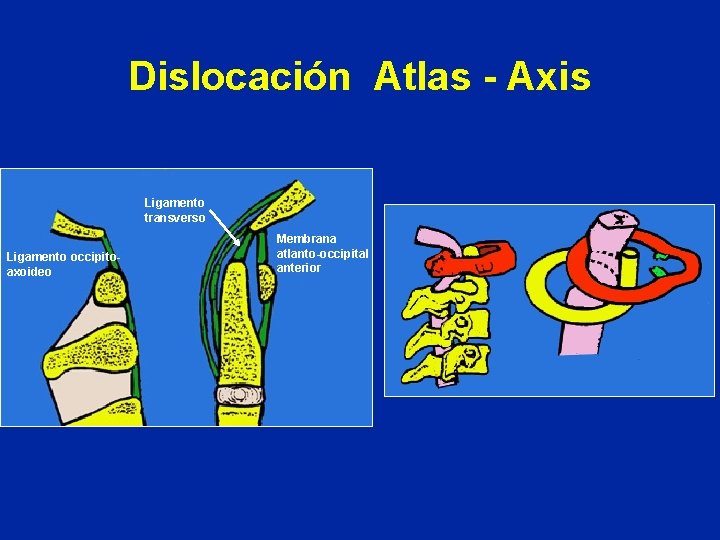 Dislocación Atlas - Axis Ligamento transverso Ligamento occipitoaxoideo Membrana atlanto-occipital anterior 