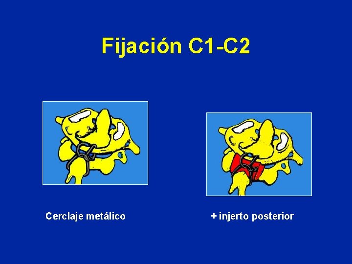Fijación C 1 -C 2 Cerclaje metálico + injerto posterior 