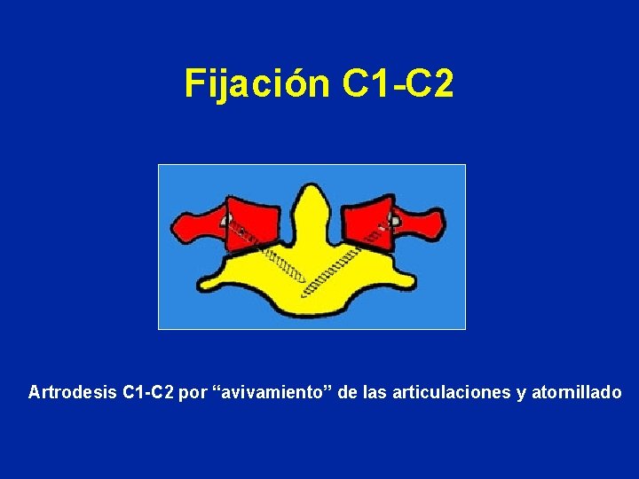 Fijación C 1 -C 2 Artrodesis C 1 -C 2 por “avivamiento” de las