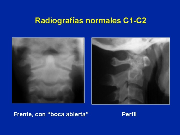 Radiografías normales C 1 -C 2 Frente, con “boca abierta” Perfil 