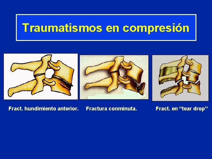 Traumatismos en compresión Fract. hundimiento anterior. Fractura conminuta. Fract. en “tear drop” 