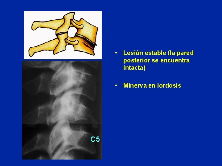  • Lesión estable (la pared posterior se encuentra intacta) • Minerva en lordosis