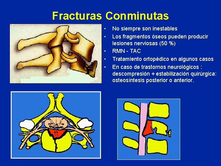 Fracturas Conminutas • • • No siempre son inestables Los fragmentos óseos pueden producir