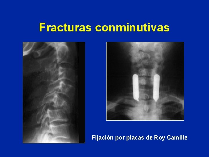 Fracturas conminutivas Fijación por placas de Roy Camille 