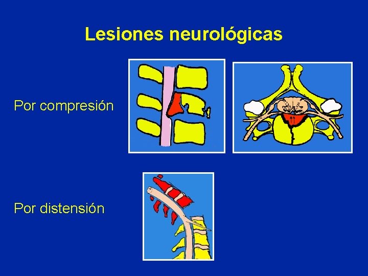 Lesiones neurológicas Por compresión Por distensión 