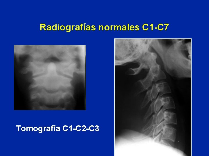 Radiografías normales C 1 -C 7 Tomografía C 1 -C 2 -C 3 