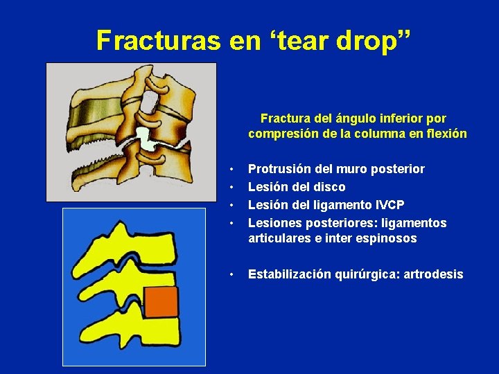 Fracturas en ‘tear drop” Fractura del ángulo inferior por compresión de la columna en