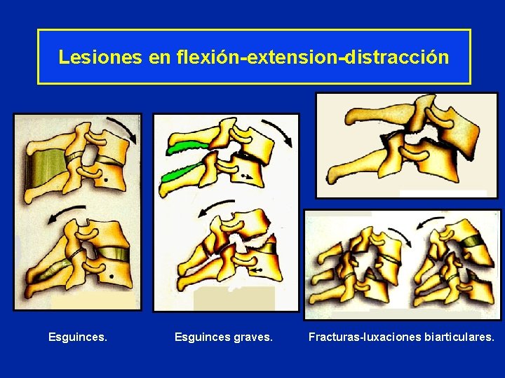 Lesiones en flexión-extension-distracción Esguinces graves. Fracturas-luxaciones biarticulares. 
