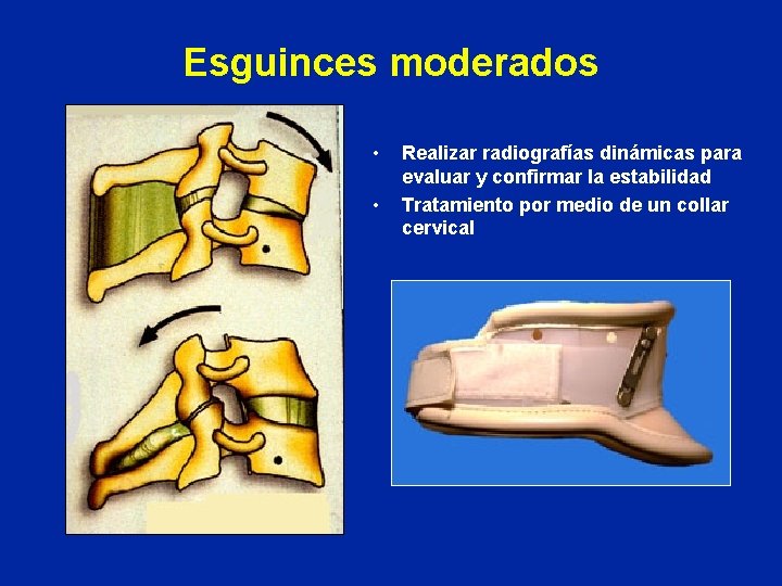 Esguinces moderados • • Realizar radiografías dinámicas para evaluar y confirmar la estabilidad Tratamiento