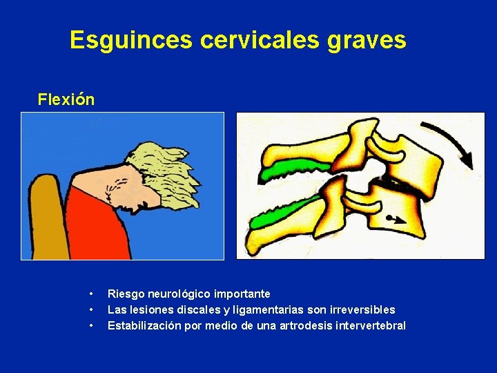 Esguinces cervicales graves Flexión • • • Riesgo neurológico importante Las lesiones discales y