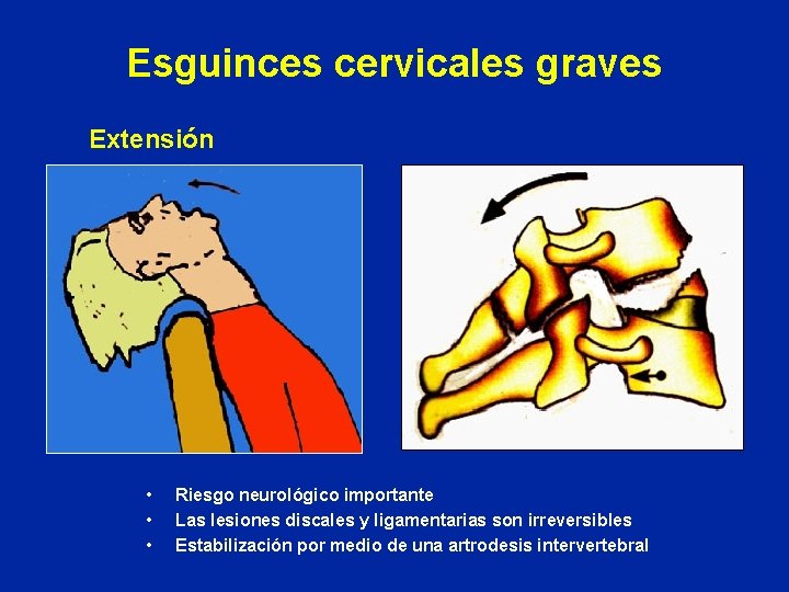 Esguinces cervicales graves Extensión • • • Riesgo neurológico importante Las lesiones discales y